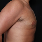 Gynecomastia Before & After Patient #29993