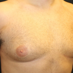 Gynecomastia Before & After Patient #29993