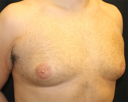 Gynecomastia Before & After Patient #29993