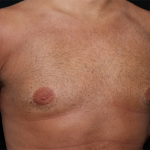 Gynecomastia Before & After Patient #29993