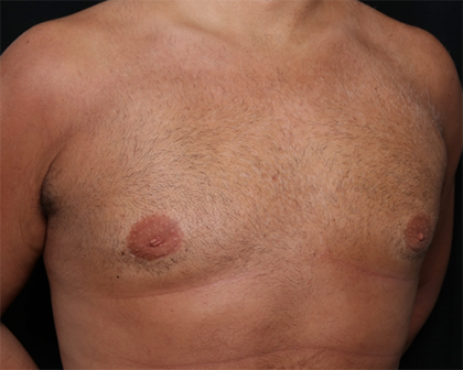 Gynecomastia Before & After Patient #29993