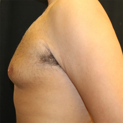 Gynecomastia Before & After Patient #29993