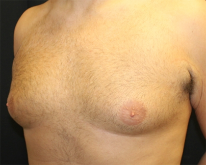 Gynecomastia Before & After Patient #29993