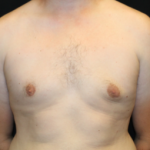 Gynecomastia Before & After Patient #29853