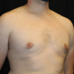 Gynecomastia Before & After Patient #29853