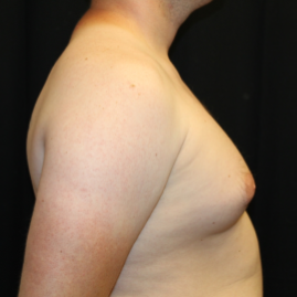 Gynecomastia Before & After Patient #29853