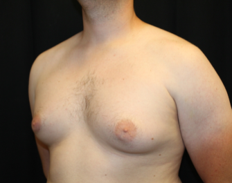 Gynecomastia Before & After Patient #29853
