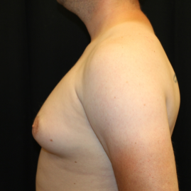 Gynecomastia Before & After Patient #29853