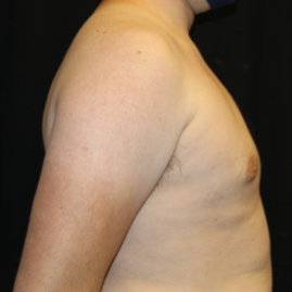 Gynecomastia Before & After Patient #29853