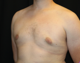 Gynecomastia Before & After Patient #29853