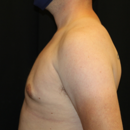 Gynecomastia Before & After Patient #29853