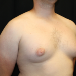 Gynecomastia Before & After Patient #29853