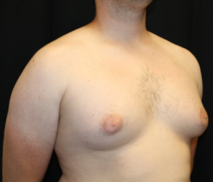 Gynecomastia Before & After Patient #29853