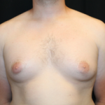 Gynecomastia Before & After Patient #29853