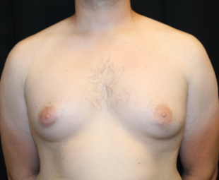 Gynecomastia Before & After Patient #29853