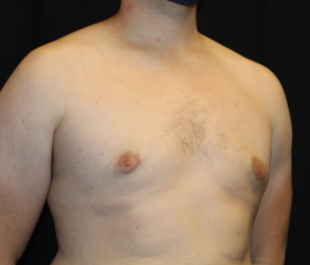 Gynecomastia Before & After Patient #29853