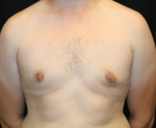 Gynecomastia Before & After Patient #29853