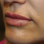 Lip Filler Before & After Patient #29873