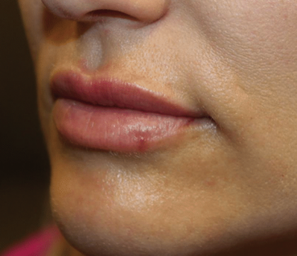 Lip Filler Before & After Patient #29873