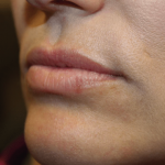 Lip Filler Before & After Patient #29873