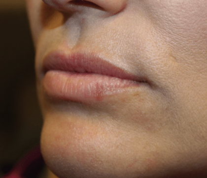 Lip Filler Before & After Patient #29873