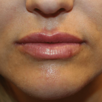 Lip Filler Before & After Patient #29873