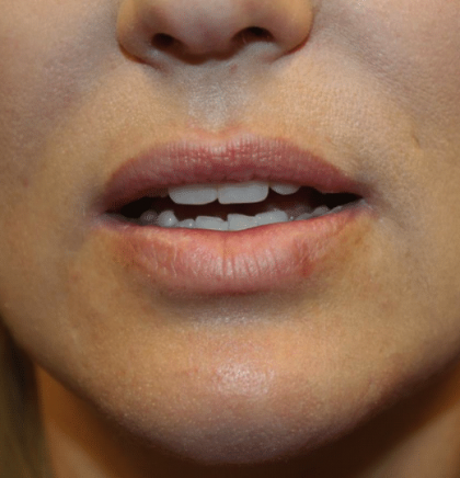 Lip Filler Before & After Patient #29873