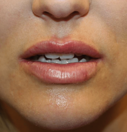 Lip Filler Before & After Patient #29873