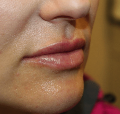 Lip Filler Before & After Patient #29873