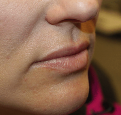 Lip Filler Before & After Patient #29873