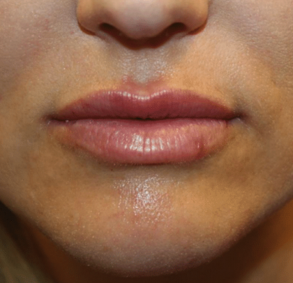 Lip Filler Before & After Patient #29873