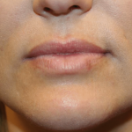 Lip Filler Before & After Patient #29873