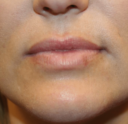 Lip Filler Before & After Patient #29873