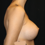 Breast Augmentation Before & After Patient #29864