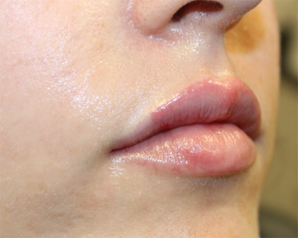 Lip Filler Before & After Patient #30130