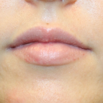 Lip Filler Before & After Patient #30130