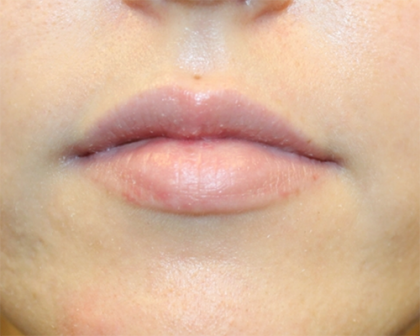 Lip Filler Before & After Patient #30130