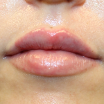 Lip Filler Before & After Patient #30130
