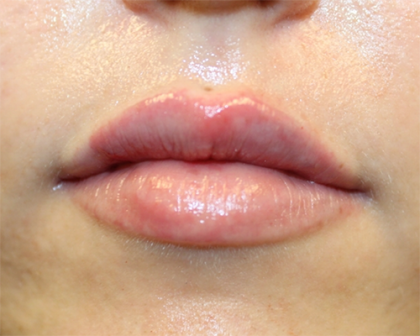 Lip Filler Before & After Patient #30130