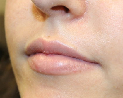 Lip Filler Before & After Patient #30130