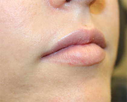 Lip Filler Before & After Patient #30130