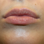 Lip Filler Before & After Patient #30162