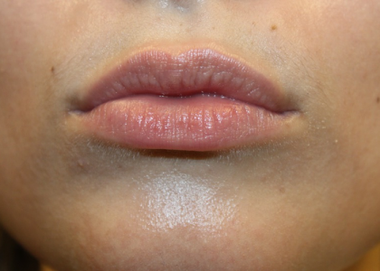 Lip Filler Before & After Patient #30162