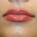 Lip Filler Before & After Patient #30162