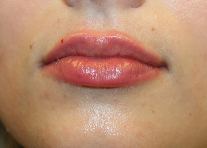 Lip Filler Before & After Patient #30162