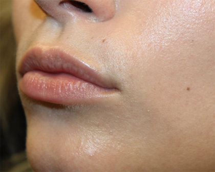 Lip Filler Before & After Patient #30162