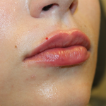 Lip Filler Before & After Patient #30162