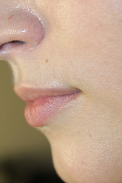 Lip Filler Before & After Patient #30162