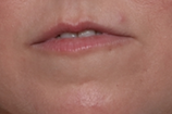 Lip Filler Before & After Patient #29980
