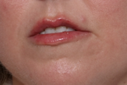 Lip Filler Before & After Patient #29980